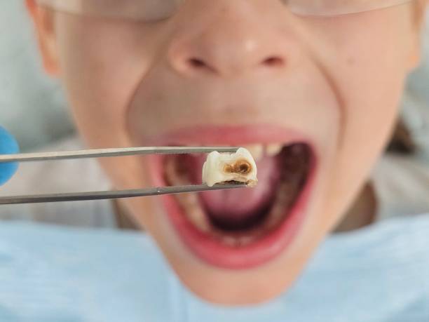 Best Emergency Tooth Extraction in Irwin, PA